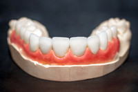 Sana-dent-veneer-7102