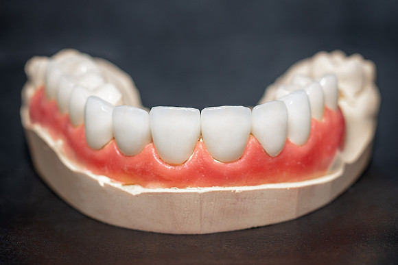 Sana-dent-veneer-7102