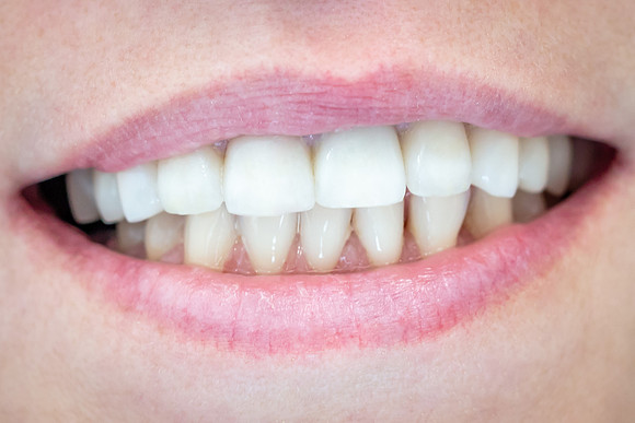 Sana-dent-teeth-after-8023