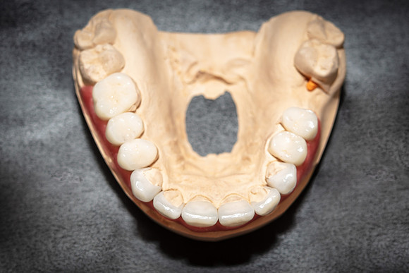 Sana-dent-teeth-veneer-7101